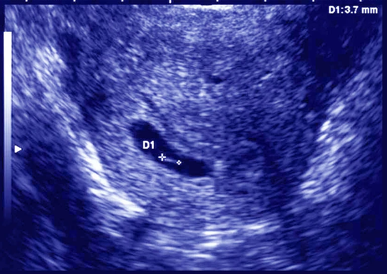 Перший місяць вагітності