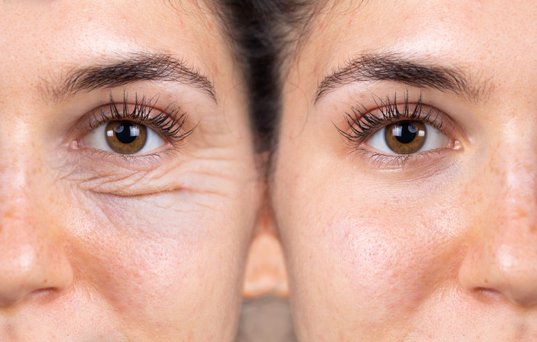 If swelling under the eyes does not go away or really bothers a person, eyelid surgery (blepharoplasty) may be necessary.