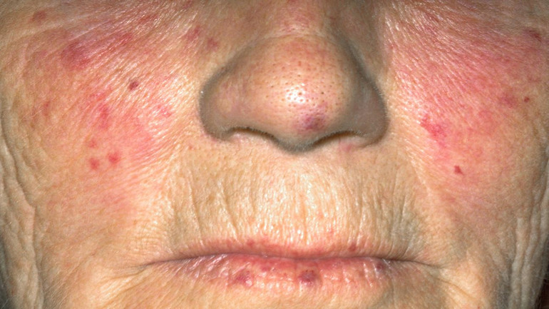 What a lupus looks like