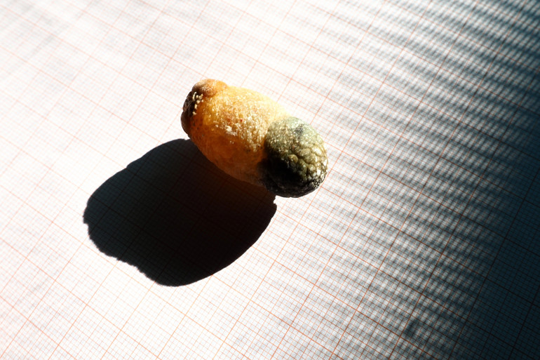 Gallstones. Illustrative photo