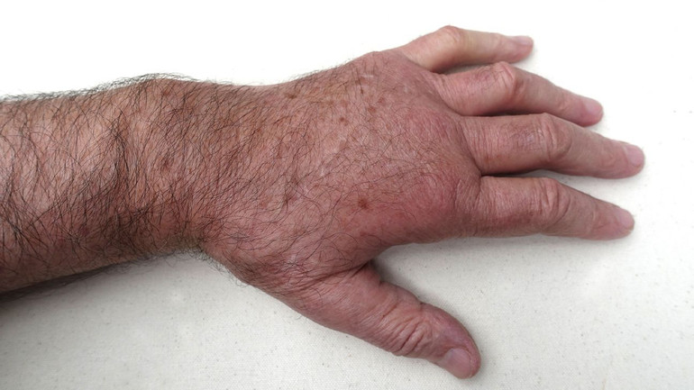 joints with lupus