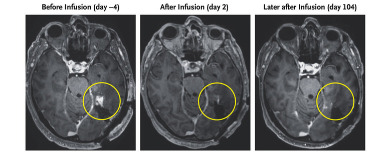 MRI of a 72-year-old patient with glioblastoma