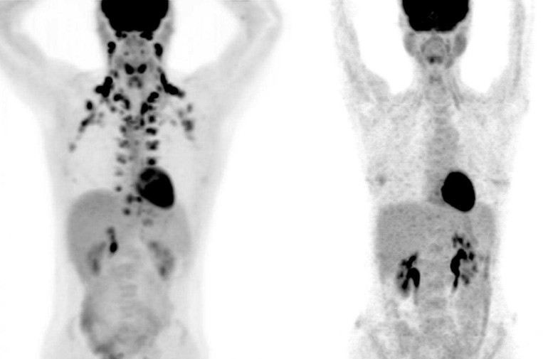 PET image of a person with brown fat (left) and without it (right).