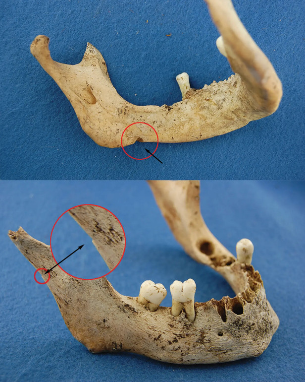 Фото нижньої щелепи Фіцджеймса, на яких видно надрізи в двох місцях, що є доказом канібалізму.