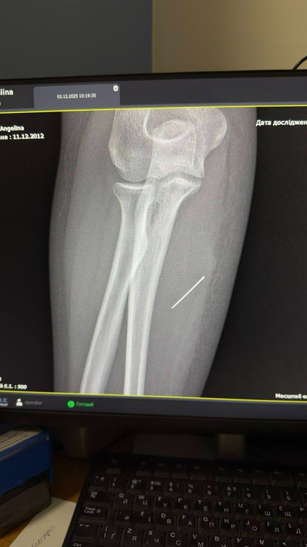 Голку витягли через невеликий розріз