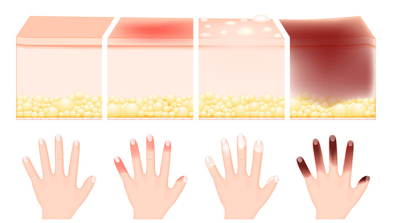 види обморожень