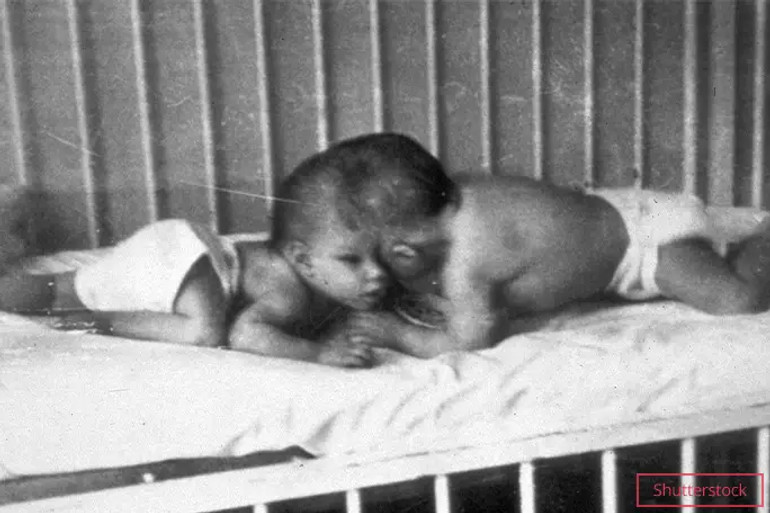 The famous Siamese twins died in the USA.  They were born same-sex, but later decided otherwise