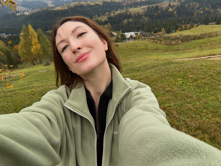 Світлана Басова має склеродермію та сидром Паррі-Ромберга