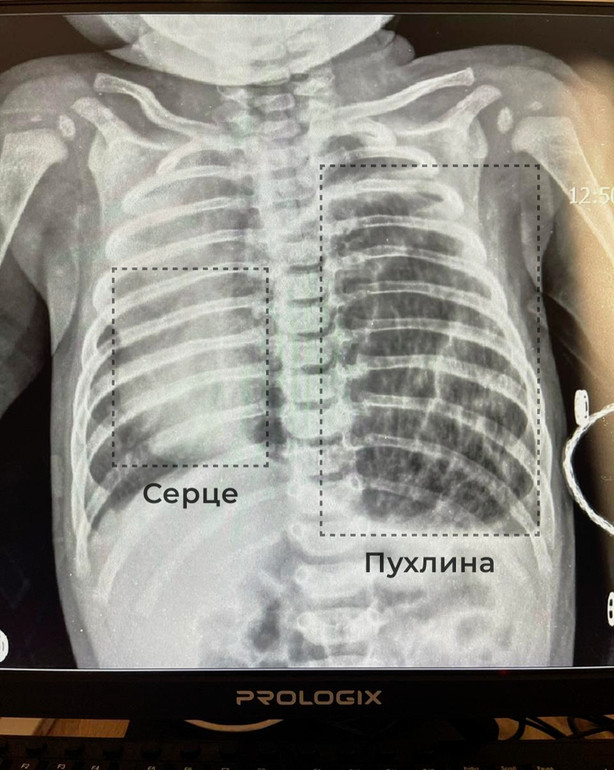 Завдяки терміновій операції дитина отримала шанс на здорове життя