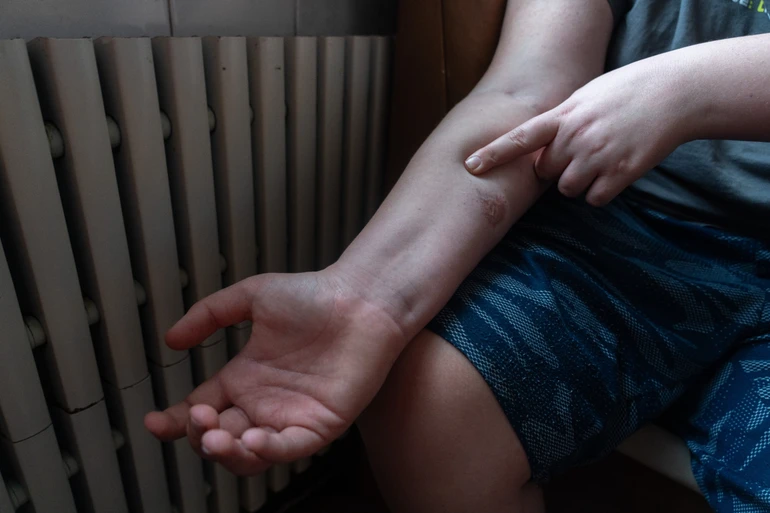 Хлопець показує сліди поранень на своєму тілі