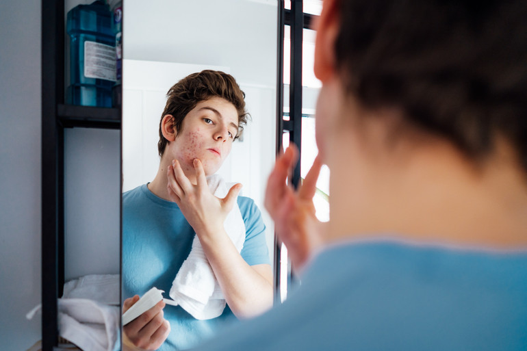 Treatment of adolescent acne