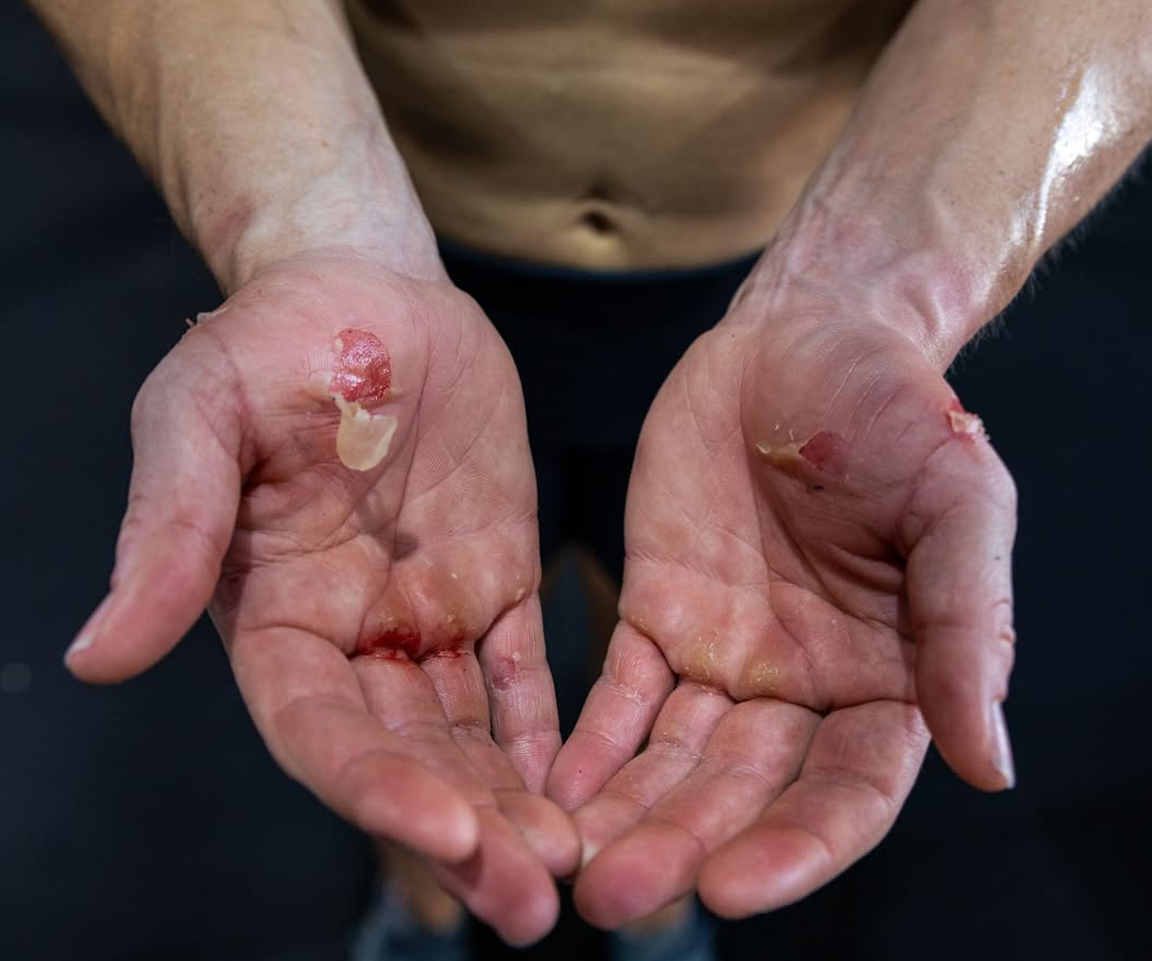 Пошкоджена шкіра на долонях