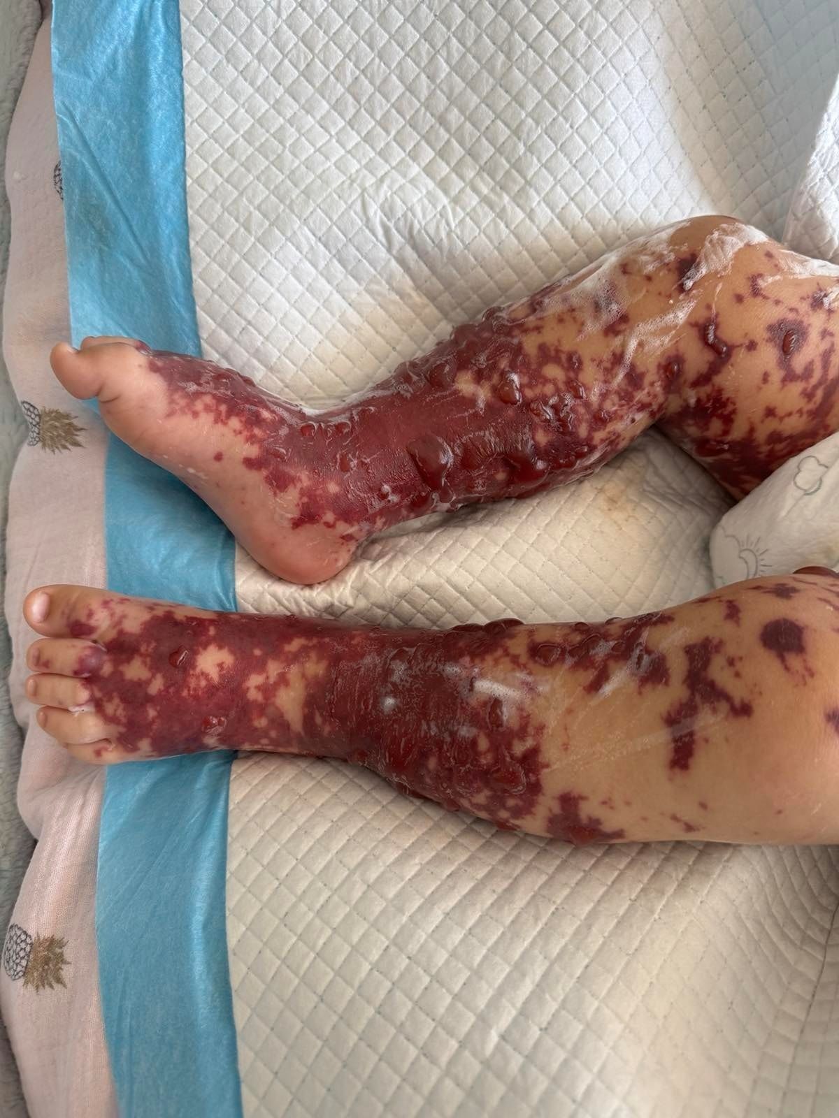 Нога дитини вражена менінгококовим сепсисом