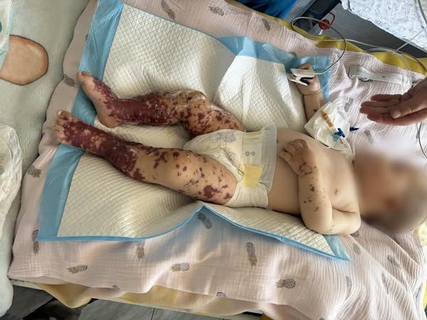 Прояви висипки в дитини